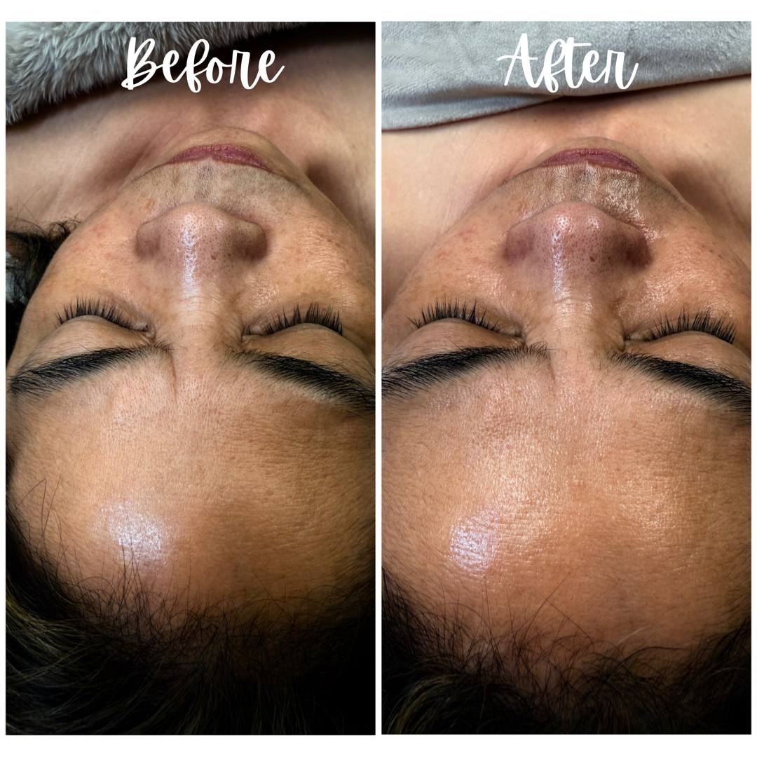 Facial glow up before and after Point Loma San Diego